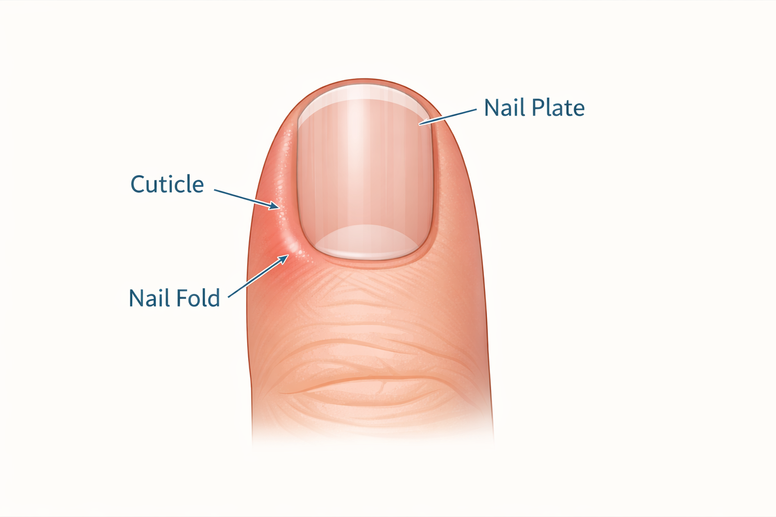 Medical illustration showing mild paronychia with redness around the nail fold