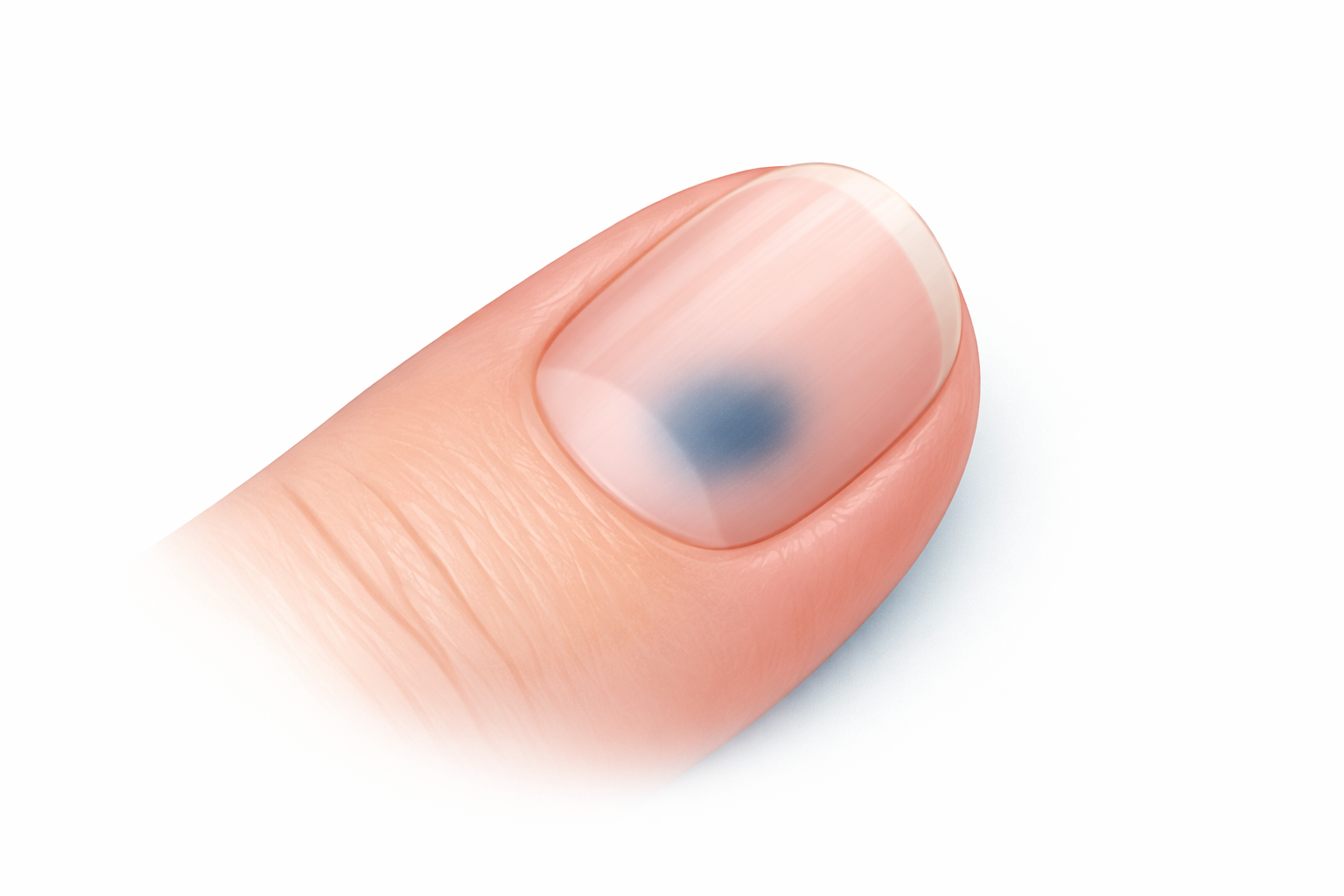 Medical illustration of a fingernail showing mild subungual discoloration from minor nail trauma, with intact smooth nail surface